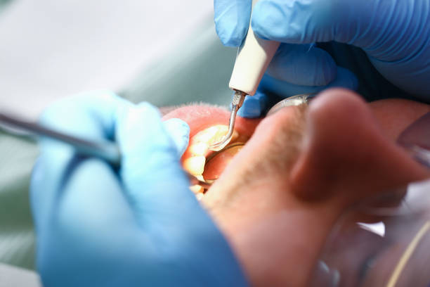 Best Emergency Wisdom Tooth Extraction in Williams, AZ